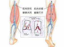 運(yùn)動(dòng)會(huì)加重靜脈曲張嗎?