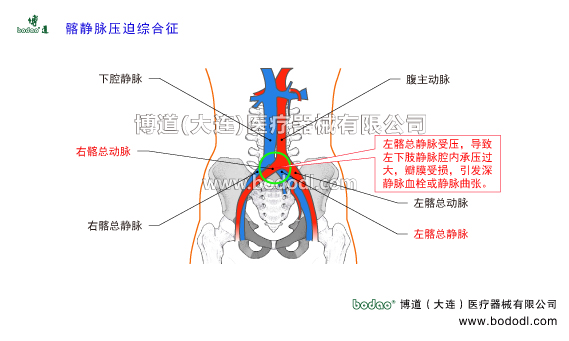 深靜脈血栓形成的預(yù)防與護(hù)理