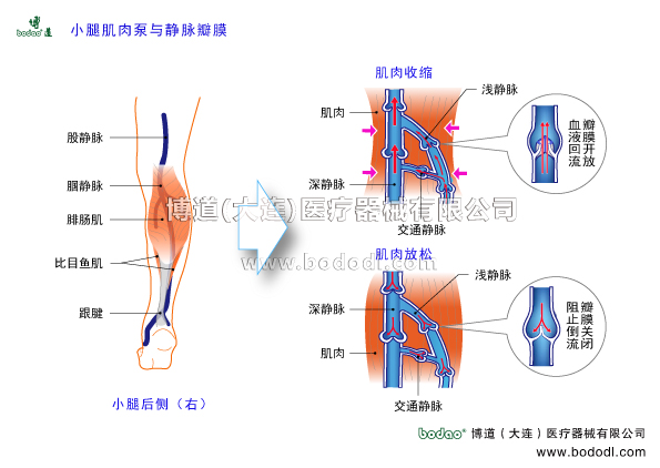 靜脈曲張的預防與治療