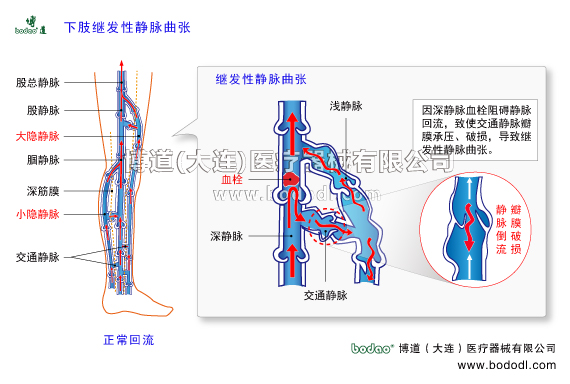靜脈曲張的預防與治療