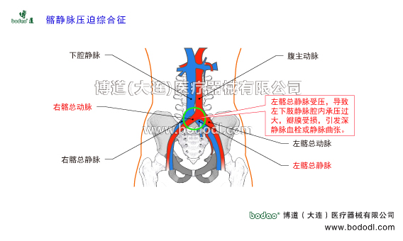 靜脈曲張的預防與治療