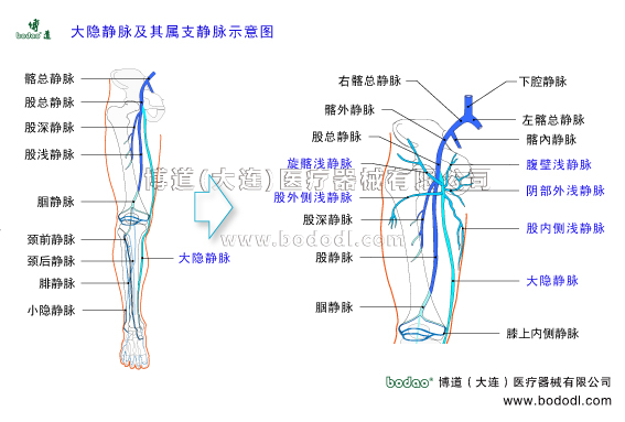 靜脈曲張的預防與治療