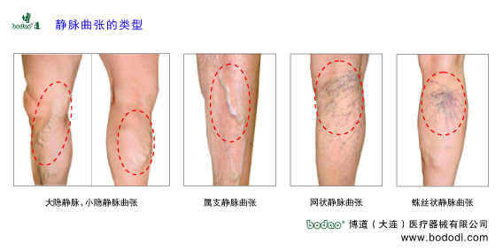靜脈曲張的預防與治療