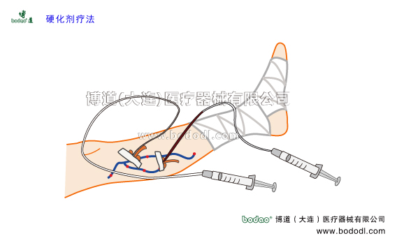 靜脈曲張的預防與治療