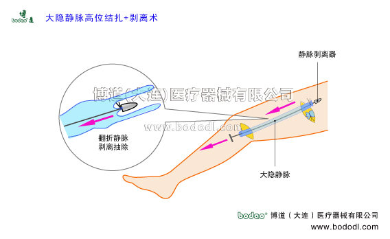 靜脈曲張的預防與治療