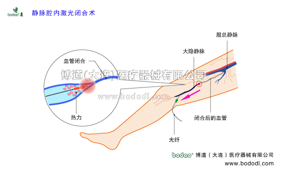 靜脈曲張的預防與治療