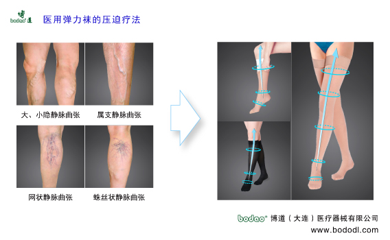 靜脈曲張的預防與治療
