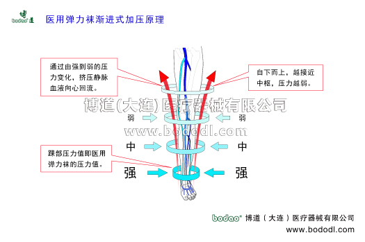 靜脈曲張的預防與治療