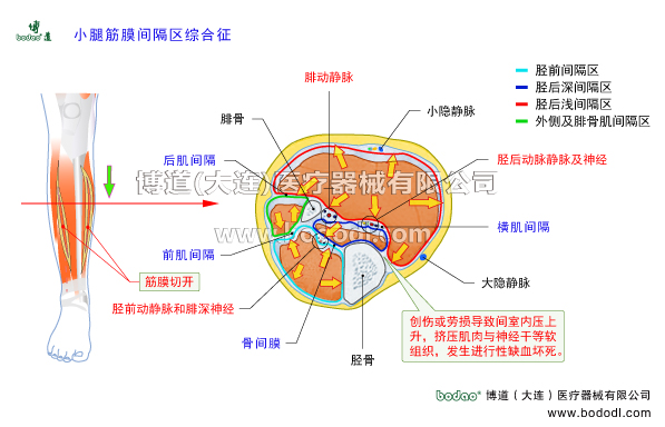 靜脈曲張的預防與治療