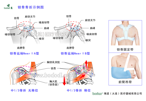鎖骨的常見(jiàn)傷病與健康防護(hù)
