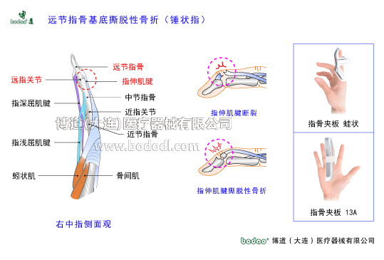 手關(guān)節(jié)常見(jiàn)傷病與健康防護(hù)