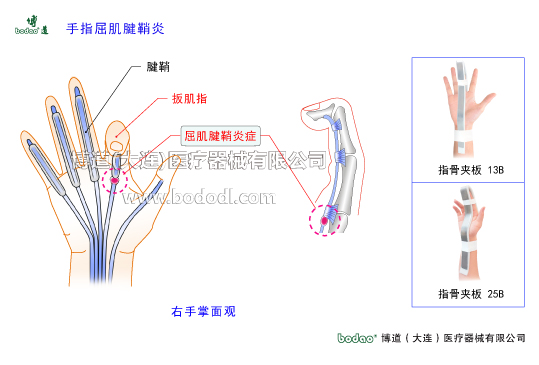 手關(guān)節(jié)常見(jiàn)傷病與健康防護(hù)