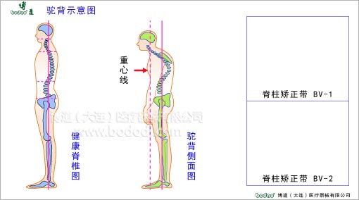 脊椎部疾病與健康護(hù)理
