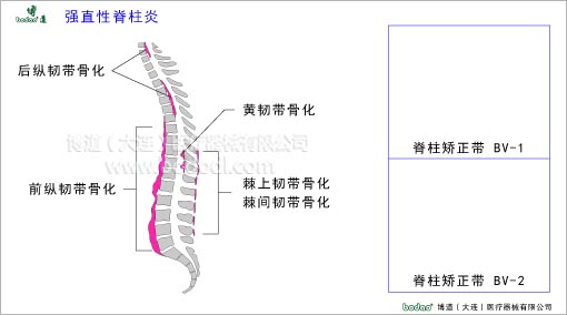 脊椎部疾病與健康護(hù)理