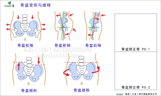 骨盆疾病與健康護(hù)理