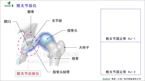 髖關(guān)節(jié)疾病與健康護(hù)理