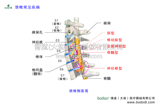 頸椎常見病頸椎病有幾種頸椎綜合癥的癥狀與治療頸型頸椎病神經(jīng)根型脊髓型頸椎病椎動(dòng)脈型交感神經(jīng)型頸椎病混合型頸椎病的病因與防護(hù)治療頸椎病的預(yù)防與治療頸椎構(gòu)造截面圖博道雙層可調(diào)式頸椎固定帶醫(yī)用矯正頸托護(hù)頸頸椎小關(guān)節(jié)不穩(wěn)頸椎骨質(zhì)增生因頸椎頸椎間盤肌肉筋膜韌帶等發(fā)生退行性改變長(zhǎng)期勞損不良姿勢(shì)外傷頸椎發(fā)育性椎管狹窄先天性畸形等因素導(dǎo)致頸椎失穩(wěn)椎間盤突出鉤椎關(guān)節(jié)突