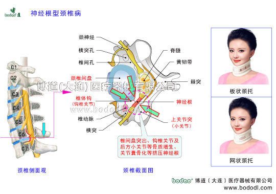 神經(jīng)根型頸椎病的病因、癥狀及防護(hù)治療，頸椎病的種類，頸椎綜合癥的治療與康復(fù)護(hù)理，神經(jīng)根型頸椎病的預(yù)防與治療博道透氣頸托頸椎固定帶頸椎間盤突出矯正支架鉤椎關(guān)節(jié)和頸椎小關(guān)節(jié)骨質(zhì)增生勞損骨刺形成小關(guān)節(jié)囊骨化鈣化關(guān)節(jié)突關(guān)節(jié)不穩(wěn)頸椎退行性病頸椎創(chuàng)傷性關(guān)節(jié)炎椎間孔狹小擠壓神經(jīng)根頸椎解剖構(gòu)造圖頸椎的構(gòu)造圍領(lǐng)護(hù)頸高度可調(diào)式頸椎固定支具頸椎骨折急救頸托頸神經(jīng)節(jié)椎動(dòng)脈椎