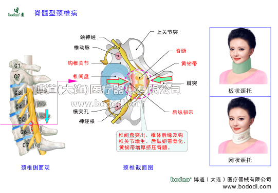 脊髓型頸椎病的原因與癥狀頸椎綜合癥的治療與康復(fù)護(hù)理博道頸椎固定帶醫(yī)用頸托頸椎間盤突出頸椎體后緣及鉤椎關(guān)節(jié)增生后縱韌帶黃韌帶增厚頸椎結(jié)構(gòu)上關(guān)節(jié)突脊髓黃韌帶棘突后縱韌帶神經(jīng)根鉤椎關(guān)節(jié)頸神經(jīng)節(jié)圍領(lǐng)護(hù)頸頸椎康復(fù)矯正固定支架高度可調(diào)式頸椎矯正牽引固定帶頸椎骨折急救固定費(fèi)城頸托支具關(guān)節(jié)囊骨化鈣化頸椎退行性病變周圍神經(jīng)脊髓型頸椎病因椎管腔變形或變窄壓迫脊髓等內(nèi)容物