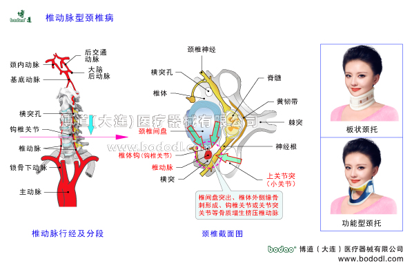 椎動(dòng)脈型頸椎病的發(fā)病原因與癥狀頸椎綜合癥的治療與康復(fù)護(hù)理博道頸托頸椎固定帶矯正帶椎動(dòng)脈行經(jīng)及分段頸椎間盤突出頸椎椎體外側(cè)緣骨質(zhì)增生骨刺形成鉤椎關(guān)節(jié)骨質(zhì)增生關(guān)節(jié)突關(guān)節(jié)骨質(zhì)增生小關(guān)節(jié)囊骨化鈣化頸椎退行性病變擠壓椎動(dòng)脈圍領(lǐng)護(hù)頸椎矯正固定支架高度可調(diào)節(jié)頸椎矯正牽引固定帶頸椎術(shù)后固定支具頸椎骨折急救固定主動(dòng)脈鎖骨下動(dòng)脈基底動(dòng)脈大腦后動(dòng)脈頸內(nèi)動(dòng)脈后交通動(dòng)脈脊髓黃