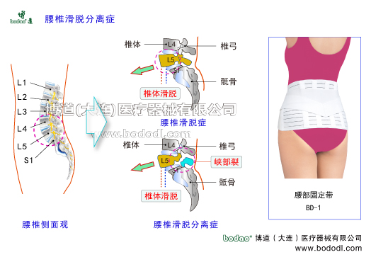 腰椎滑脫癥腰椎分離癥腰椎峽部裂腰椎滑脫分離癥腰椎峽部不連腰椎滑脫分離的主要癥狀與治療博道腰部固定帶醫(yī)用護腰腰椎軟骨退行性病變腰椎積累性損傷椎間孔狹窄壓迫神經(jīng)根坐骨神經(jīng)炎腰椎間盤突出癥髓核破裂椎弓椎體骶骨椎管神經(jīng)根脊神經(jīng)節(jié)前縱韌帶后縱韌帶椎間關(guān)節(jié)馬尾綜合征關(guān)節(jié)突關(guān)節(jié)變形腰肌勞損腰背肌筋膜炎腰骶部慢性損傷閃腰急性腰扭傷腰椎的結(jié)構(gòu)解剖腰骶關(guān)節(jié)勞損骶髂關(guān)節(jié)炎馬尾綜合癥腰椎固定帶腰圍第四第五腰椎滑脫第一骶椎博