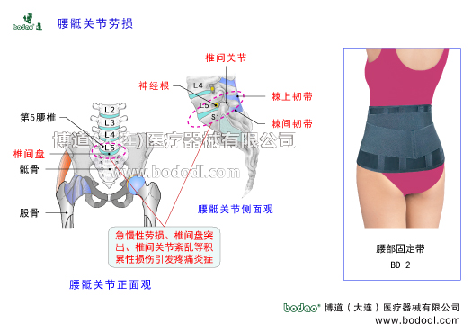 腰骶關(guān)節(jié)勞損腰骶關(guān)節(jié)炎的癥狀與治療腰骶關(guān)節(jié)在哪里腰骶關(guān)節(jié)形成角度120°是活動性腰椎轉(zhuǎn)變?yōu)楣潭ㄐ憎咀登巴寡缔D(zhuǎn)變?yōu)楹笸棍咀档倪^渡區(qū)中心。博道腰部固定帶透氣性醫(yī)用護腰。慢性腰骶關(guān)節(jié)勞損的發(fā)病原因豎脊肌臀大肌腰骶關(guān)節(jié)腰椎間盤腰椎小關(guān)節(jié)韌帶擠壓椎間盤韌帶損傷撕裂腰椎滑脫分離峽部裂關(guān)節(jié)突骨折椎間盤突出骶髂關(guān)節(jié)下肢關(guān)節(jié)骶髂關(guān)節(jié)韌帶松弛骶棘肌腰骶棘間韌帶腰骶關(guān)節(jié)突腰扭傷勞損增生腰椎間盤突出骨質(zhì)疏松退行性病變密切
