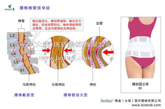 腰椎椎管狹窄癥的主要癥狀與治療博道醫(yī)用護腰腰部固定帶。腰椎間盤突出、腰椎骨質(zhì)增生、黃韌帶增厚腰椎小關(guān)節(jié)增生椎間關(guān)節(jié)退變關(guān)節(jié)突關(guān)節(jié)不穩(wěn)腰椎滑脫分離腰椎峽部裂等擠壓椎管脊髓馬尾神經(jīng)及腰椎神經(jīng)腰椎軟骨退行性病變腰椎積累性損傷腰椎出血滲出鈣化骨橋?qū)е伦甸g孔狹窄壓迫神經(jīng)根而發(fā)病，導致坐骨神經(jīng)炎。腰肌勞損髓核破裂突出椎間關(guān)節(jié)增生變形引發(fā)馬尾綜合征腰椎固定帶腰椎部主要病癥腰椎管結(jié)構(gòu)解剖圖腰椎小關(guān)節(jié)增生腰骶關(guān)節(jié)勞損