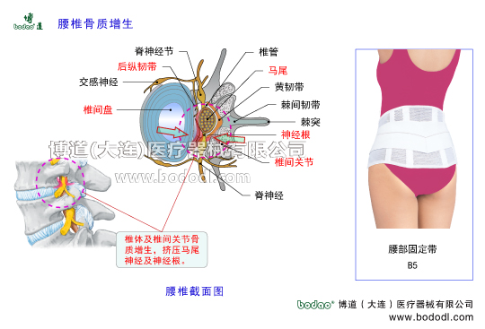 腰椎骨質(zhì)增生及其主要癥狀、腰椎增生的發(fā)病原因及治療與防護腰椎骨刺形成腰椎軟骨退行性病變及腰椎間盤膨出腰椎積累性損傷導致腰椎增生博道醫(yī)用護腰部固定帶的主要功能腰椎出血滲出鈣化唇樣骨質(zhì)增生骨橋椎間孔狹窄擠壓神經(jīng)根引發(fā)坐骨神經(jīng)炎，腰椎勞損神經(jīng)根交感神經(jīng)脊神經(jīng)節(jié)前縱韌帶后縱韌帶黃韌帶棘間韌帶棘上韌帶腰椎小關(guān)節(jié)囊椎間關(guān)節(jié)變形腰部軟組織勞損腰骶部慢性損傷腰椎部主要病癥閃腰急性筋膜損傷腰椎的構(gòu)造腰骶關(guān)節(jié)勞損馬尾神