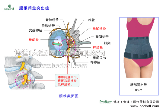 腰椎間盤突出癥的主要癥狀與治療博道醫(yī)用護腰椎固定帶腰椎退行性改變腰椎勞損髓核破裂突出椎管神經(jīng)根脊神經(jīng)節(jié)交感神經(jīng)馬尾神經(jīng)前縱韌帶后縱韌帶棘間韌帶腰椎椎間關(guān)節(jié)增生椎間盤膨出椎間盤退變馬尾綜合征關(guān)節(jié)突關(guān)節(jié)變形腰肌勞損腰背肌筋膜炎腰椎部及腰骶部軟組織慢性勞損腰椎間盤退化急性腰背肌筋膜損傷腰椎的構(gòu)造解剖圖腰椎小關(guān)節(jié)紊亂腰部固定帶透氣護腰帶腰圍腰托腰椎矯正固定牽引支具腰椎矯正器腰椎固定支具腰疼帶博道護腰透氣護腰