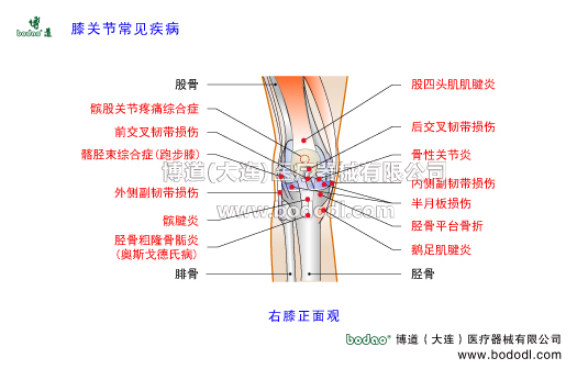 膝關(guān)節(jié)常見疾病及其預(yù)防與治療，膝關(guān)節(jié)半月板損傷，髕前滑囊炎髕腱炎跳躍膝，髕股關(guān)節(jié)炎，博道醫(yī)用膝關(guān)節(jié)固定帶，髕股關(guān)節(jié)綜合證髕骨軟化癥髕骨脫位，膝關(guān)節(jié)滑膜炎骨性關(guān)節(jié)炎滑囊炎，髂脛束綜合征跑步膝，半月板損傷，交叉十字韌帶內(nèi)側(cè)外側(cè)副韌帶損傷，脛股粗隆骨骺病脛骨結(jié)節(jié)軟骨病骨骺炎奧斯戈德氏病生長(zhǎng)痛，髕下滑囊炎髕下脂肪墊損傷鵝足肌腱炎右膝正面觀，膝關(guān)節(jié)可調(diào)式卡盤固定護(hù)膝支架，膝關(guān)節(jié)置換脛骨平臺(tái)骨折髕骨骨折固定支架