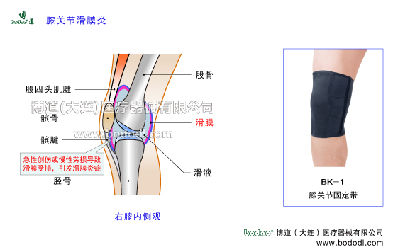 膝關(guān)節(jié)滑膜炎膝關(guān)節(jié)囊損傷博道加壓護(hù)膝醫(yī)用保暖矯形固定護(hù)膝，膝關(guān)節(jié)滑膜炎的主要癥狀與治療博道膝關(guān)節(jié)固定帶BK-1醫(yī)用護(hù)膝哪個(gè)好？膝關(guān)節(jié)常見疾病的治療與護(hù)理，戶外運(yùn)動(dòng)護(hù)膝排行榜，股四頭肌腱髕骨臏腱髕韌帶滑液脛骨滑膜膝關(guān)節(jié)囊，右膝側(cè)面觀，膝關(guān)節(jié)軟組織損傷矯正固定支具，膝關(guān)節(jié)骨折專業(yè)固定康復(fù)矯形支具，膝關(guān)節(jié)面膝關(guān)節(jié)腔，膝關(guān)節(jié)滑膜結(jié)締組織，滑膜的功能與作用，膝關(guān)節(jié)急性創(chuàng)傷或慢性勞損，膝關(guān)節(jié)腔內(nèi)積血積液引發(fā)非感