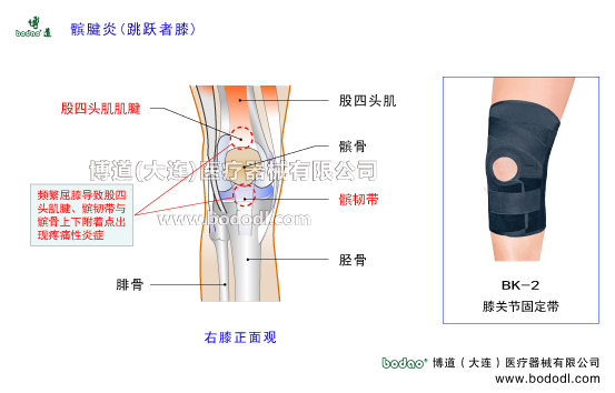 髕腱炎跳躍者，膝股四頭肌肌腱炎，博道髕腱加壓固定帶，透氣性膝關(guān)節(jié)加壓固定帶JK帶膝關(guān)節(jié)固定帶BK-2髕腱炎加壓護(hù)膝排行榜，臏腱炎跳躍者膝股四頭肌腱炎的病因與預(yù)防治療，肌腱炎加壓固定帶哪家好。膝關(guān)節(jié)常見疾病博道透氣護(hù)膝戶外運(yùn)動(dòng)矯形保暖護(hù)膝，股骨髕骨臏腱髕韌帶脛骨滑膜膝關(guān)節(jié)囊，膝關(guān)節(jié)矯正帶髕前韌帶髕下韌帶，髕韌帶長(zhǎng)度及主要功能與作用，膝關(guān)節(jié)伸膝裝置與屈膝裝置。髕腱炎是長(zhǎng)期勞損引起髕韌帶上下附著點(diǎn)出現(xiàn)疼痛