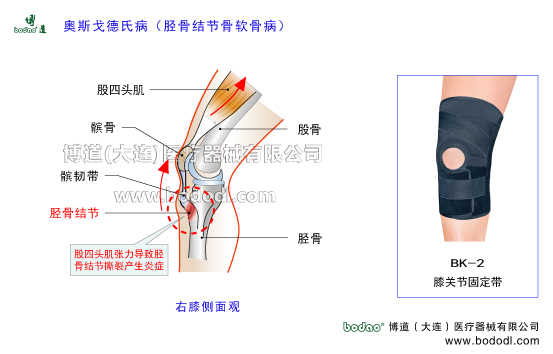 奧斯戈德氏病Osgood-Schlatter病脛骨結(jié)節(jié)骨軟骨病的主要癥狀脛骨粗隆骨骺炎的原因與治療方法癥狀生長(zhǎng)痛的原因癥狀與加壓矯正護(hù)膝脛骨結(jié)節(jié)軟骨病的癥狀與加壓防護(hù)及治療方法脛骨粗隆骨骺炎的癥狀與加壓固定治療跳躍者膝股四頭肌肌腱炎膝關(guān)節(jié)伸膝裝置矯正固定帶膝關(guān)節(jié)固定帶BK-2膝關(guān)節(jié)常見疾病博道運(yùn)動(dòng)保暖護(hù)膝股四頭肌腱臏腱髕韌帶日本透氣護(hù)膝膝關(guān)節(jié)韌帶軟骨損傷矯形固定支具脛骨結(jié)節(jié)骨骺疾病的原因與治療O型腿