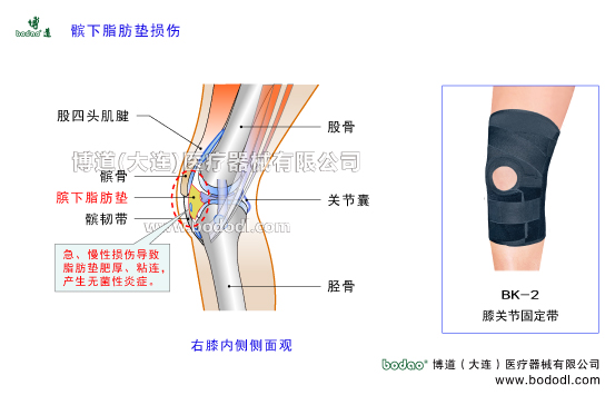 髕下脂肪墊損傷髕下脂肪墊炎Hoffa病脂肪墊勞損脂肪墊損傷，髕下脂肪墊損傷的主要癥狀與康復(fù)治療，博道透氣性醫(yī)用護(hù)膝膝關(guān)節(jié)固定帶BK-2，膝關(guān)節(jié)常見疾病，博道戶外運(yùn)動(dòng)透氣性加壓護(hù)膝排行榜，矯形保暖護(hù)膝股骨股四頭肌腱髕骨韌帶損傷臏腱髕韌帶膝關(guān)節(jié)囊膝關(guān)節(jié)軟組織損傷固定支具髕下脂肪墊的形狀和功能膝關(guān)節(jié)囊內(nèi)呈三角形脂肪組織翼狀皺襞。髕下脂肪墊具有加強(qiáng)膝關(guān)節(jié)穩(wěn)定潤(rùn)滑關(guān)節(jié)組織和減少髕骨髕韌帶與關(guān)節(jié)囊骨關(guān)節(jié)面的摩擦