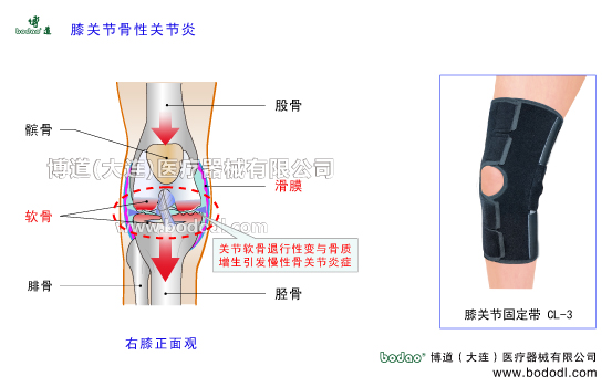 膝關(guān)節(jié)骨性關(guān)節(jié)炎發(fā)病原因OA、Osteoarthrosis膝關(guān)節(jié)退行性關(guān)節(jié)病膝關(guān)節(jié)增生性骨關(guān)節(jié)炎繼發(fā)性膝關(guān)節(jié)骨性關(guān)節(jié)炎和原發(fā)性膝關(guān)節(jié)骨性關(guān)節(jié)炎膝關(guān)節(jié)炎保暖矯形護(hù)膝關(guān)節(jié)軟骨防護(hù)固定護(hù)膝膝關(guān)節(jié)骨質(zhì)增生矯正固定帶膝關(guān)節(jié)慢性關(guān)節(jié)炎矯形固定帶護(hù)膝膝關(guān)節(jié)骨性關(guān)節(jié)炎的主要癥狀與治療護(hù)理，博道透氣性醫(yī)用護(hù)膝排名，膝關(guān)節(jié)固定帶哪家好CL-3膝關(guān)節(jié)常見疾病博道保暖護(hù)膝膝關(guān)節(jié)軟骨滑膜膝關(guān)節(jié)囊，日本透氣護(hù)膝膝關(guān)節(jié)軟組織損傷