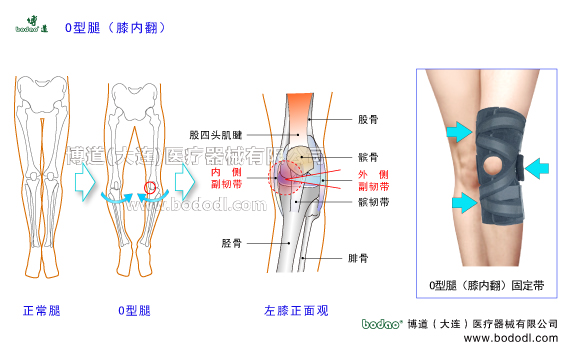 O型腿羅圈腿膝內(nèi)翻下肢畸形疾病。膝關(guān)節(jié)的構(gòu)造，O型腿膝內(nèi)翻的病因、癥狀及治療方法。O型腿膝內(nèi)翻的危害與預(yù)防治療。O型腿膝內(nèi)翻的保守治療與手術(shù)治療及康復(fù)護(hù)理。膝關(guān)節(jié)退行性骨性關(guān)節(jié)炎。博道O型腿膝內(nèi)翻專用透氣性醫(yī)用護(hù)膝排名，膝關(guān)節(jié)加壓固定帶矯形保暖護(hù)膝日本透氣護(hù)膝膝關(guān)節(jié)固定矯形支架膝關(guān)節(jié)內(nèi)側(cè)半月板內(nèi)側(cè)副韌帶，膝關(guān)節(jié)外側(cè)半月板外側(cè)副韌帶的矯正固定。女性O(shè)型腿膝內(nèi)翻患病率多于男性的原因。
