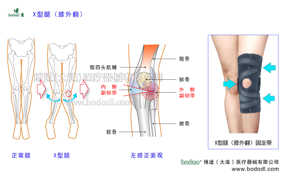 X型腿膝外翻下肢畸形疾病。膝關(guān)節(jié)的構(gòu)造，X型腿膝外翻的發(fā)病原因、癥狀及治療方法。X型腿膝外翻的危害與治療方法。X型腿膝外翻的保守治療與手術(shù)治療及康復(fù)護(hù)理。膝關(guān)節(jié)退行性骨性關(guān)節(jié)炎。博道X型腿膝外翻專用加壓矯形護(hù)膝，膝關(guān)節(jié)加壓固定帶矯形保暖護(hù)膝日本透氣護(hù)膝膝關(guān)節(jié)固定矯形支架膝關(guān)節(jié)內(nèi)側(cè)半月板內(nèi)側(cè)副韌帶的矯正固定，膝關(guān)節(jié)外側(cè)半月板外側(cè)副韌帶的矯正固定。女性X型腿膝外翻患病率多于男性的原因。