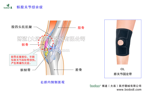 髕股關(guān)節(jié)疼痛綜合癥的病因及癥狀PFPS髕骨軟化癥專用加壓護(hù)膝髕骨脫位膝關(guān)節(jié)退行性關(guān)節(jié)病膝關(guān)節(jié)增生性骨關(guān)節(jié)炎博道透氣性膝關(guān)節(jié)固定帶CL-1膝關(guān)節(jié)常見疾病矯形保暖護(hù)膝膝關(guān)節(jié)軟骨髕韌帶股四頭肌腱右膝側(cè)面觀膝關(guān)節(jié)矯正帶髕股關(guān)節(jié)主要功能是確保膝關(guān)節(jié)屈伸時(shí)髕骨在股骨髁間切跡中上下滑動(dòng)完成屈伸跳躍等動(dòng)作髕股關(guān)節(jié)的穩(wěn)定性主要依靠股四頭肌腱髕骨髂脛束和股內(nèi)側(cè)斜肌的動(dòng)力性因素也依靠膝關(guān)節(jié)囊股骨髁髕骨內(nèi)外側(cè)支持帶和臏股韌