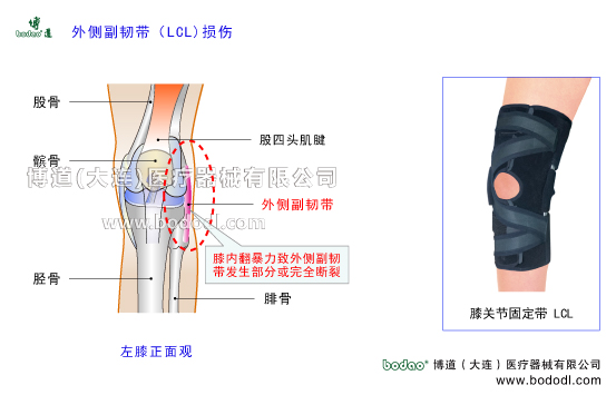膝關(guān)節(jié)外側(cè)副韌帶損傷的原因、癥狀與康復(fù)治療。博道透氣性膝關(guān)節(jié)外側(cè)副韌帶LCL固定帶，膝關(guān)節(jié)損傷固定支具O型腿矯正固定X型腿矯正固定膝關(guān)節(jié)骨質(zhì)增生內(nèi)側(cè)半月板損傷斷裂矯正康復(fù)固定，外側(cè)半月板損傷斷裂矯正與康復(fù)固定膝關(guān)節(jié)外傷護(hù)膝支架支具哪家好。膝關(guān)節(jié)加壓固定帶排行榜博道LCL加壓護(hù)膝關(guān)節(jié)外側(cè)副韌帶損傷固定帶膝關(guān)節(jié)LCL損傷的預(yù)防與治療膝關(guān)節(jié)外側(cè)副韌帶損傷可調(diào)節(jié)式固定夾板LCL外側(cè)副韌帶重建固定支架