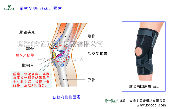 膝關(guān)節(jié)前交叉韌帶ACL損傷的原因、癥狀及治療方法。博道膝關(guān)節(jié)醫(yī)用固定帶膝關(guān)節(jié)ACL前交叉韌帶損傷斷裂的治療與護(hù)理可調(diào)節(jié)式膝關(guān)節(jié)前交叉韌帶固定夾板膝關(guān)節(jié)軟組織損傷固定矯正支架膝關(guān)節(jié)骨質(zhì)增生膝關(guān)節(jié)外傷等防護(hù)與術(shù)后固定護(hù)膝博道加壓護(hù)膝前十字ACL韌帶損傷固定帶膝關(guān)節(jié)ACL前交叉韌帶前十字韌帶損傷防護(hù)固定膝關(guān)節(jié)的構(gòu)造ACL前交叉韌帶前十字韌帶重建康復(fù)固定膝關(guān)節(jié)疾病的預(yù)防與治療膝關(guān)節(jié)疾病的治療與康復(fù)護(hù)理博道加