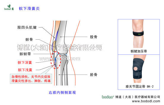 髕下滑囊炎膝關(guān)節(jié)髕下滑囊炎的病因癥狀與防護(hù)治療方法。髕下深囊脛骨粗隆腱下囊髕下滑囊炎的防護(hù)與治療。髕下滑囊的構(gòu)造與功能。髕下淺囊皮下囊及脛骨粗隆皮下囊。股四頭肌腱。膝關(guān)節(jié)髕下滑囊炎的癥狀與博道膝關(guān)節(jié)固定帶的防護(hù)功能，髕腱加壓帶JK帶可調(diào)式膝關(guān)節(jié)卡盤固定支架透氣性醫(yī)用護(hù)膝，下肢腿部術(shù)后固定夾板日本護(hù)膝腿部骨折固定夾板。醫(yī)用加壓護(hù)膝BK-2具有減輕膝關(guān)節(jié)壓力和摩擦、增加襯墊和滑動(dòng)、保護(hù)髕韌帶與脛骨免于相