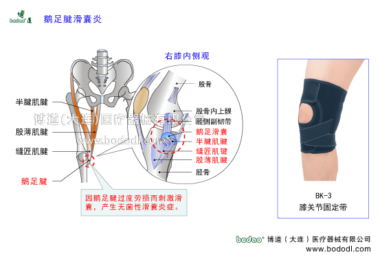 鵝足腱滑囊炎。鵝足肌腱炎的病因、癥狀與防護(hù)治療。蛙泳膝與脛骨內(nèi)髁炎因肌腱過度使用癥候群，鵝足腱加壓固定帶博道醫(yī)用護(hù)膝，鵝足腱滑囊炎專用護(hù)膝，鵝足腱的構(gòu)造，膝關(guān)節(jié)固定帶BK-3透氣性加壓護(hù)膝。鵝足腱由縫匠肌腱股薄肌腱半腱肌腱組成，止于膝下脛骨內(nèi)側(cè)因形同鵝足而得名具有防止下肢行走跑步時(shí)的外向旋轉(zhuǎn)功能。鵝足腱滑囊是封閉性囊，不與膝關(guān)節(jié)相通，在膝關(guān)節(jié)11個(gè)滑囊中位置特殊具有減少肌腱組織摩擦增加滑動(dòng)的作用