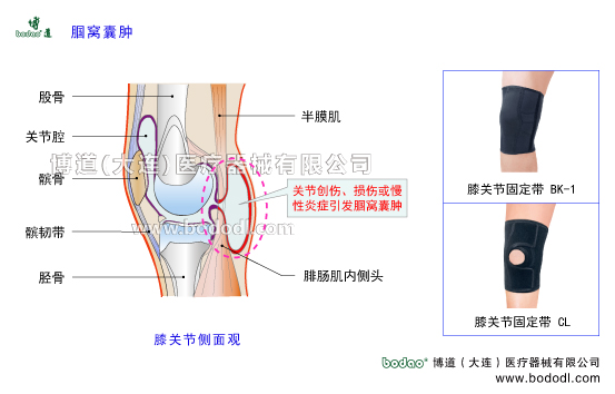 腘窩囊腫，貝克囊、Baker\'s cyst膝關(guān)節(jié)構(gòu)造，膝關(guān)節(jié)腔的結(jié)構(gòu)，股骨脛骨髕骨的構(gòu)造，博道醫(yī)用膝關(guān)節(jié)固定帶BK-1、CL-1透氣性醫(yī)用加壓護(hù)膝的防護(hù)效果，腘窩囊腫的病因、癥狀及康復(fù)治療與護(hù)理，腘窩囊腫加壓固定帶，膝關(guān)節(jié)角度可調(diào)式卡盤固定支架半月板損傷固定支具戶外運(yùn)動(dòng)加壓護(hù)膝，膝蓋骨折固定夾板日本透氣護(hù)膝，膝關(guān)節(jié)韌帶軟骨等軟組織損傷康復(fù)固定夾板，下肢腿部術(shù)后固定夾板，股骨髕骨脛骨腓骨骨折專業(yè)固定夾