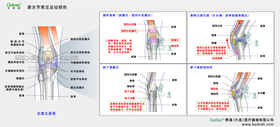 膝關(guān)節(jié)運動損傷的類型與癥狀