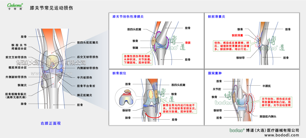 膝關(guān)節(jié)運動損傷的類型與癥狀