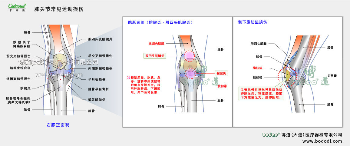 膝關(guān)節(jié)運(yùn)動損傷的類型與癥狀