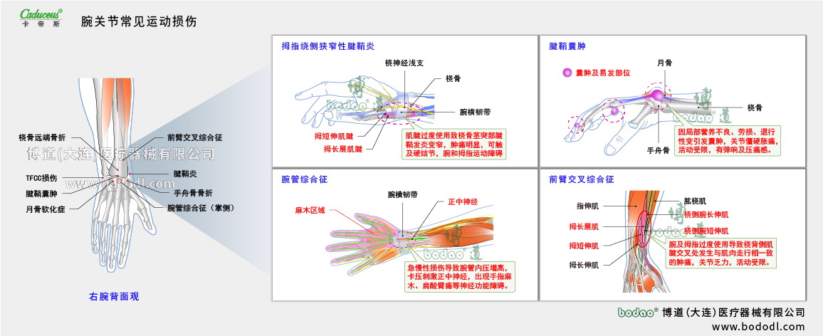 腕關(guān)節(jié)運(yùn)動損傷的類型與癥狀
