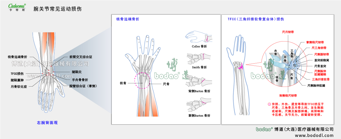 腕關(guān)節(jié)運動損傷的類型與癥狀