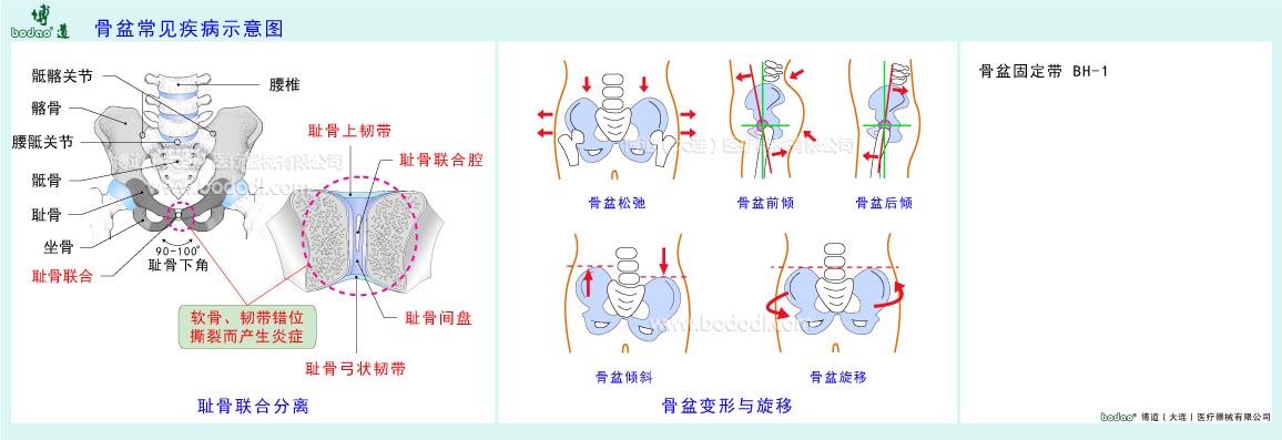 骨盆常見疾病示意圖