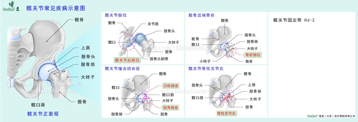 髖關(guān)節(jié)常見疾病示意圖